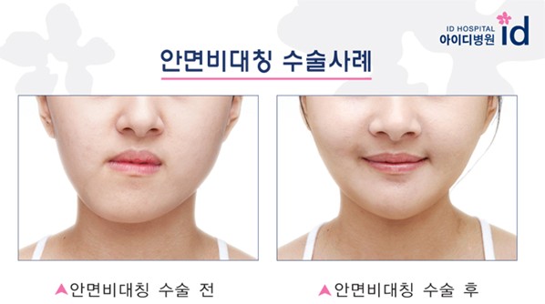 韩国整形专家解析脸部不对称问题 3人中有1人不对称