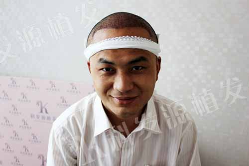 张青松：我之最 一次植发三种技术